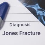 Overview of Jones Fractures on the Foot