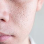 The Myths of Shrinking Pores, Unplugged