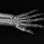 Diagnosing and Treating a Colles Fracture