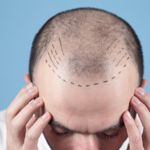 Should You Travel Abroad for Hair Transplant Surgery?