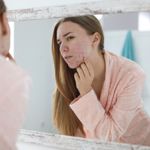 What Causes Acne?