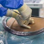 Lumbar Puncture for Diagnosis and Treatment