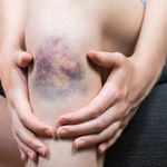 Hematoma Types and Treatments
