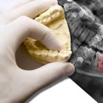Does Everyone Have Their Wisdom Teeth Removed?