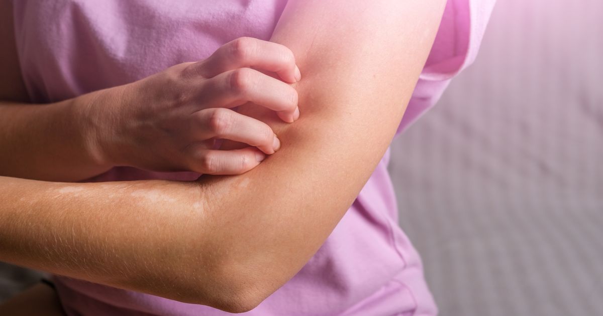 Signs and Symptoms of Hives Facty Health