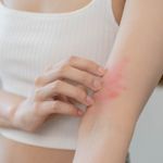 10 Possible Causes of Hives