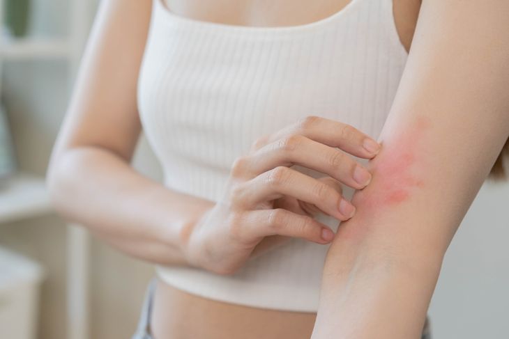 10 Possible Causes of Hives