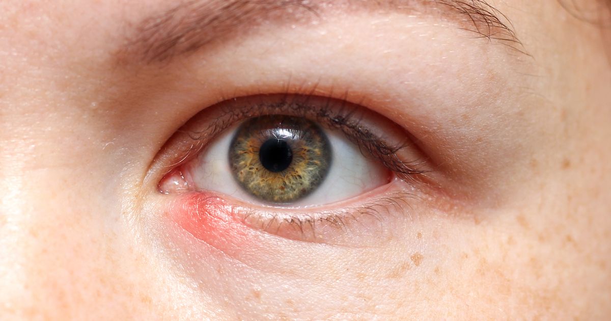 Symptoms and Signs of a Stye Facty Health