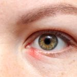 Symptoms and Signs of a Stye