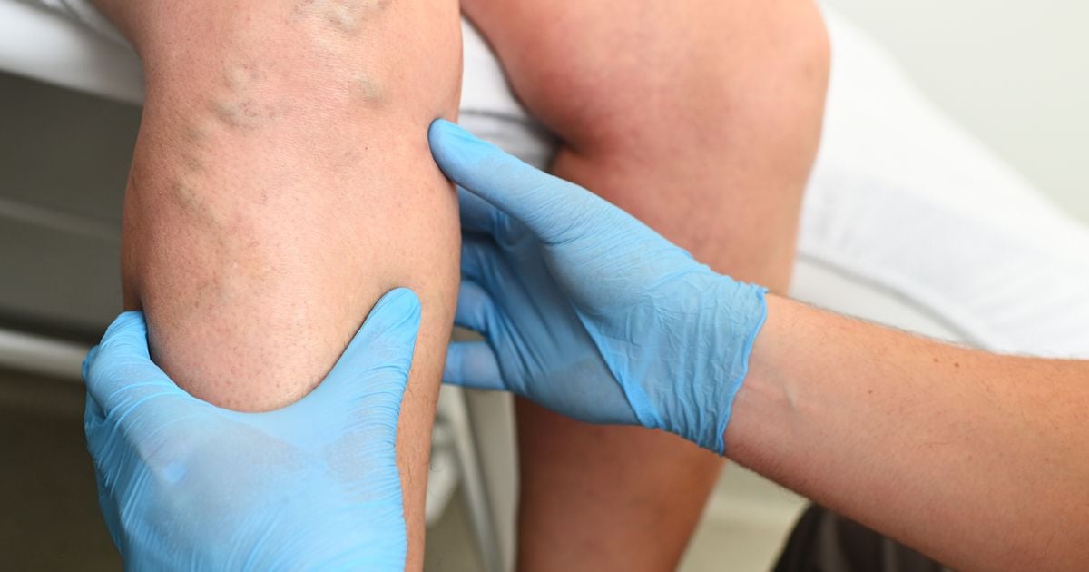 Tips for Preventing Blood Clots Facty Health