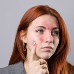 Foods that Trigger Rosacea