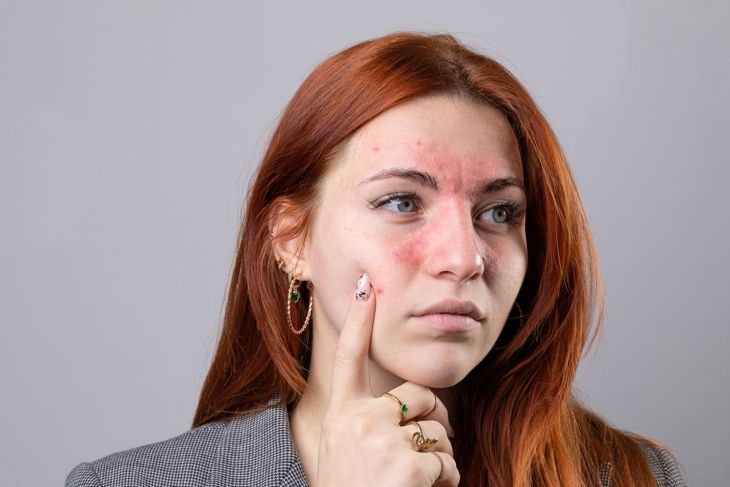 Foods that Trigger Rosacea