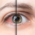 15 Natural Remedies for Relief From Dry Eyes