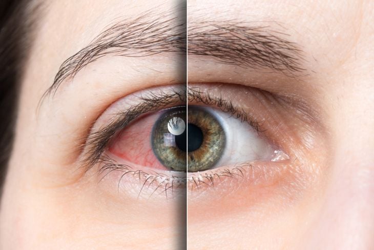 15 Natural Remedies for Relief From Dry Eyes