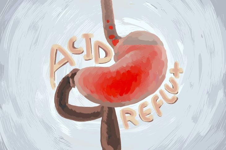 Illustration of a stomach and esophagus with red irritation marks, surrounded by swirling gray brushstrokes. The words “ACID REFLUX” appear in bold, stylized lettering around the inflamed area.