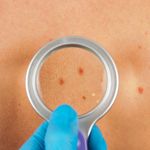 What Causes Cysts and When to Worry