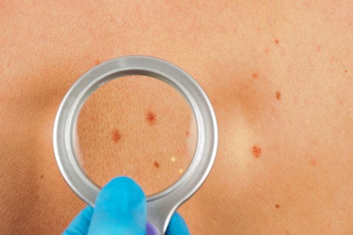 What Causes Cysts and When to Worry