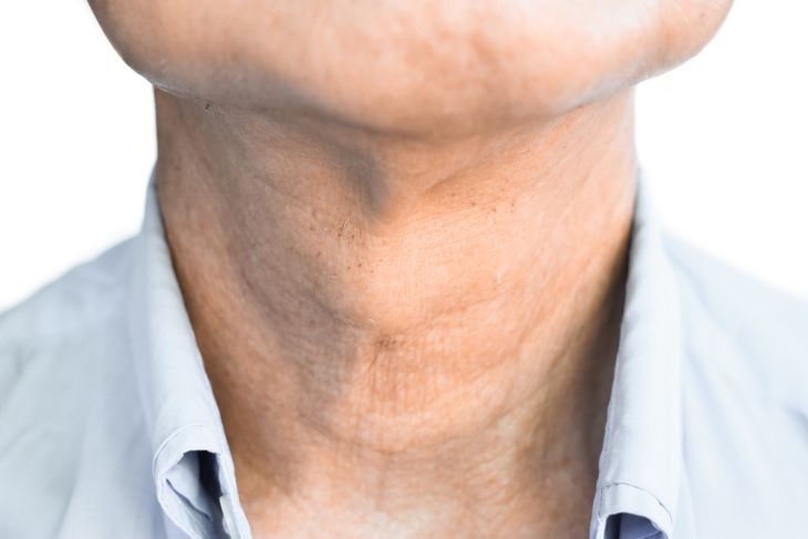 A close-up of an older person’s neck with a slightly raised area, illustrating how most nodules are benign—even when visible—and emphasizing the importance of monitoring changes for signs of cancer. 