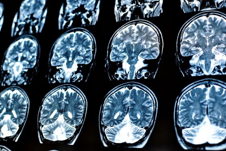 A series of brain MRI scans showing multiple cross-sectional images, illustrating how brain cysts can appear on imaging and may need monitoring or treatment based on their size and effects. 