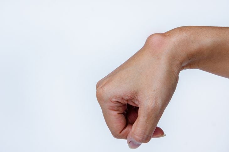 A hand with a prominent, round lump on the wrist against a plain white background, demonstrating how cysts can form beneath the skin due to various causes like blocked glands or inflammation. 