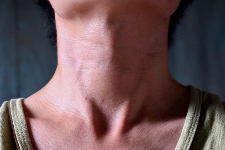A close-up of a person’s neck with a visible swelling or lump, highlighting how nodules can develop from various causes and sometimes require medical evaluation. 
