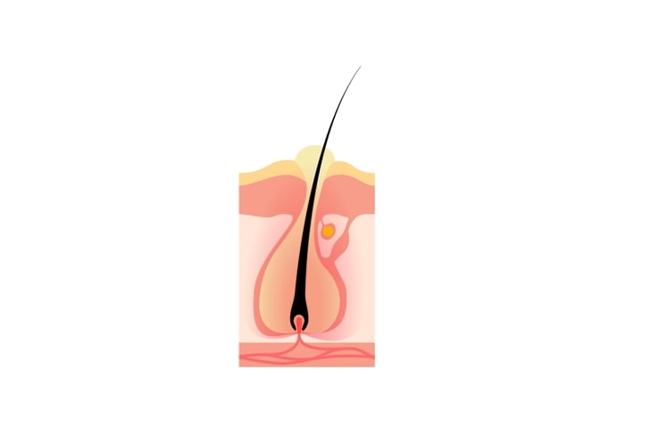 A medical illustration of a hair follicle cross-section shows a cyst forming under the skin near the hair shaft, helping distinguish cysts from boils by their appearance and location. 