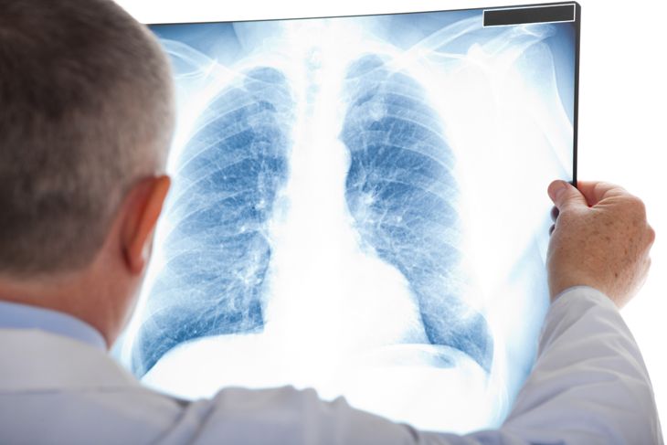 A doctor examines a chest X-ray, emphasizing how lung nodules are usually found on scans rather than through noticeable symptoms, but sometimes require further tests if they grow or cause problems. 