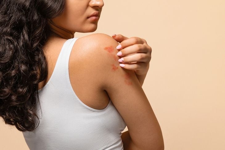 A woman in a white tank top touches her shoulder, which has visible red, scaly patches, highlighting neem’s traditional and researched uses for soothing skin conditions like eczema and psoriasis. 