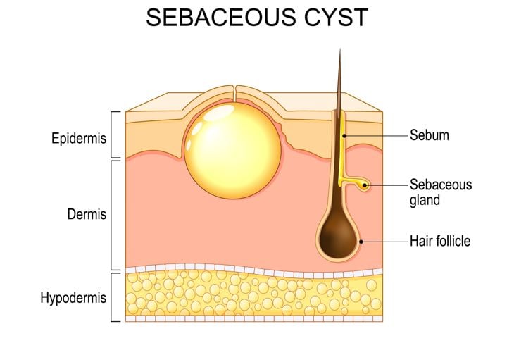 A medical illustration shows a cross-section of skin labeled epidermis, dermis, and hypodermis, featuring a large yellow sebaceous cyst near a hair follicle and sebaceous gland, depicting how these cysts form beneath the skin. 