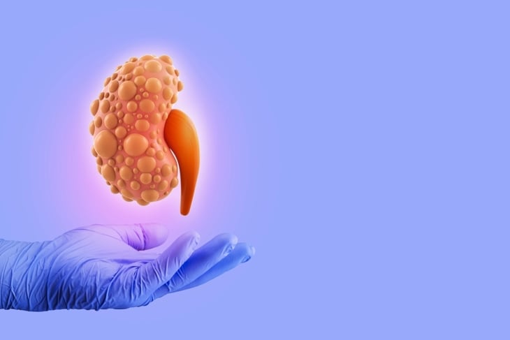 A gloved hand is held out beneath a digital illustration of a kidney covered in multiple rounded cysts, representing how kidney cysts can develop—sometimes requiring monitoring but often causing no symptoms. 