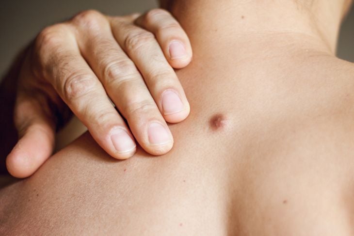 A close-up of a person's hand resting on their bare shoulder, next to a small, raised cyst—showing how cysts can develop just beneath the skin and may vary in contents depending on where they form. 
