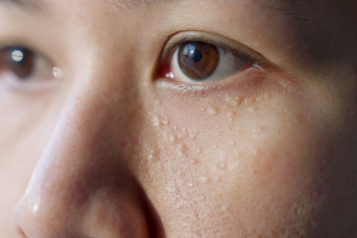 A close-up of a person’s face with small, white bumps beneath the skin around the cheek and lower eye, illustrating how some cysts appear as smooth, firm lumps on the surface. 