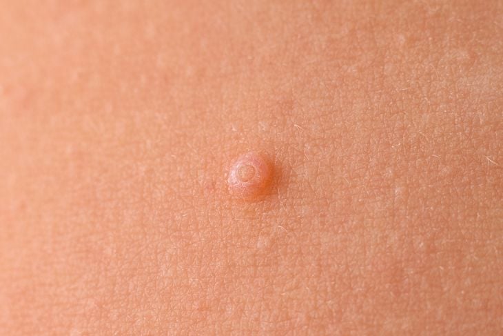A close-up of a small, raised, round bump on the skin, showing how some nodules can appear as firm, painless lumps beneath the surface. 