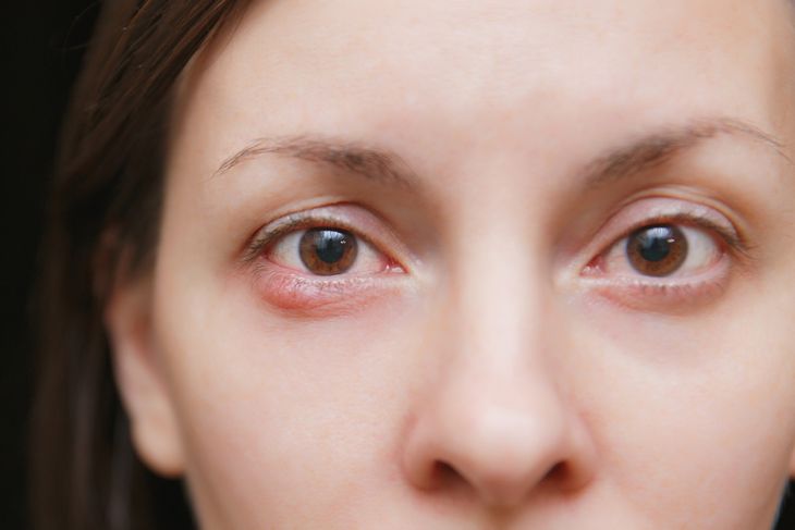 A close-up of a woman's face showing a visible, swollen nodule beneath her lower eyelid, illustrating how nodules can develop in noticeable areas under the skin. 