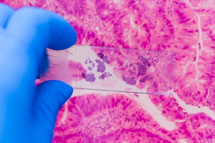 Scientist in blue gloves hand holding glasses slide breast tissue on out of focus cancer tissue picture background