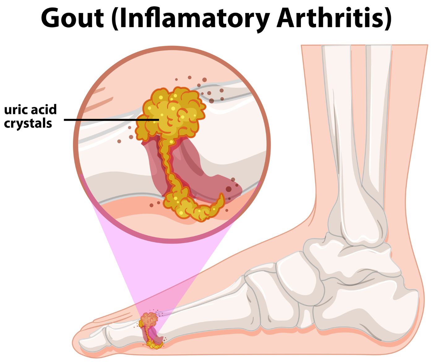 What Causes Gout? Facty Health