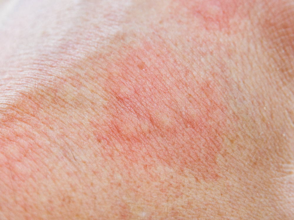Symptoms Of Staph Infection Facty Health