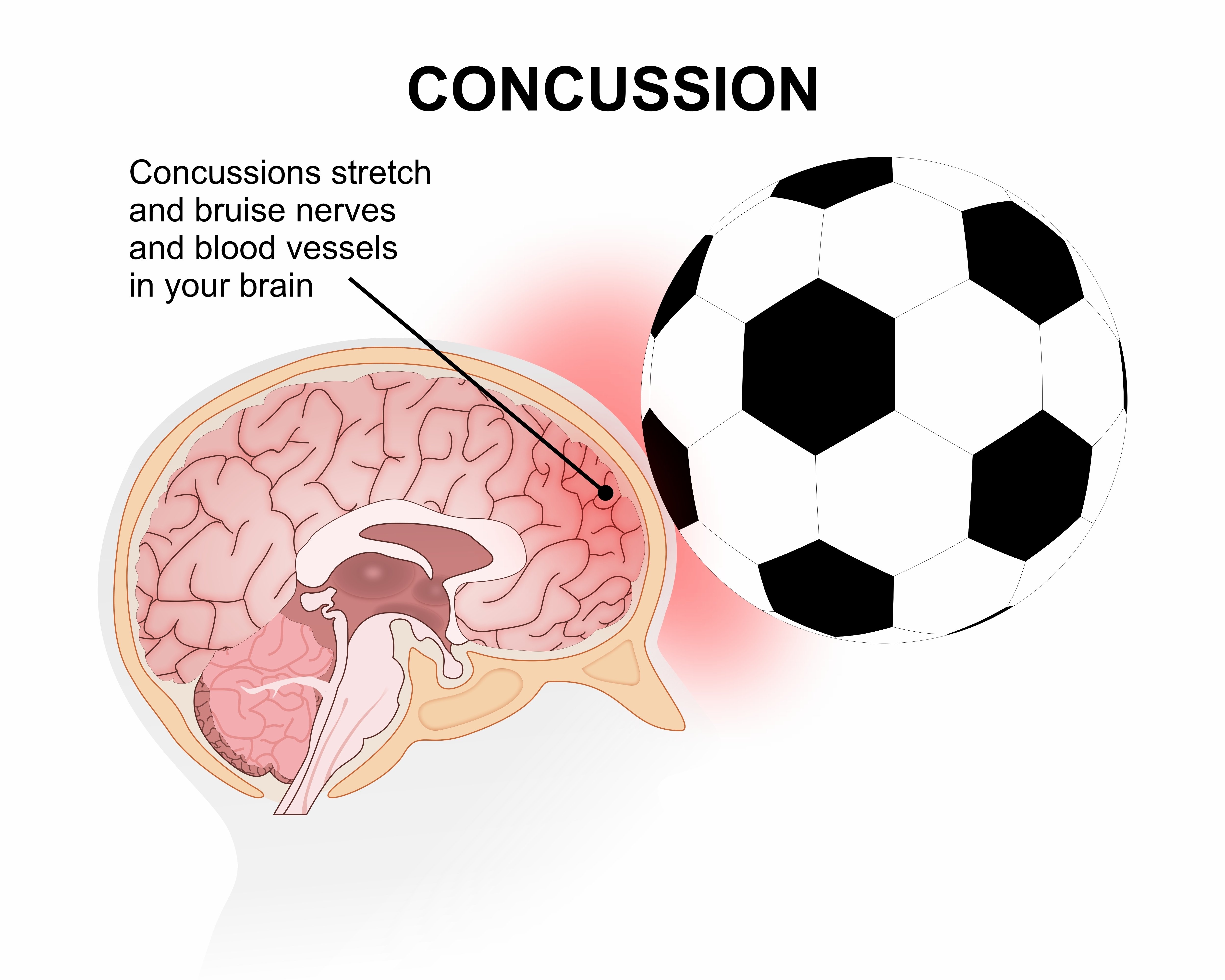 Concussion traumatic brain injury illustration
