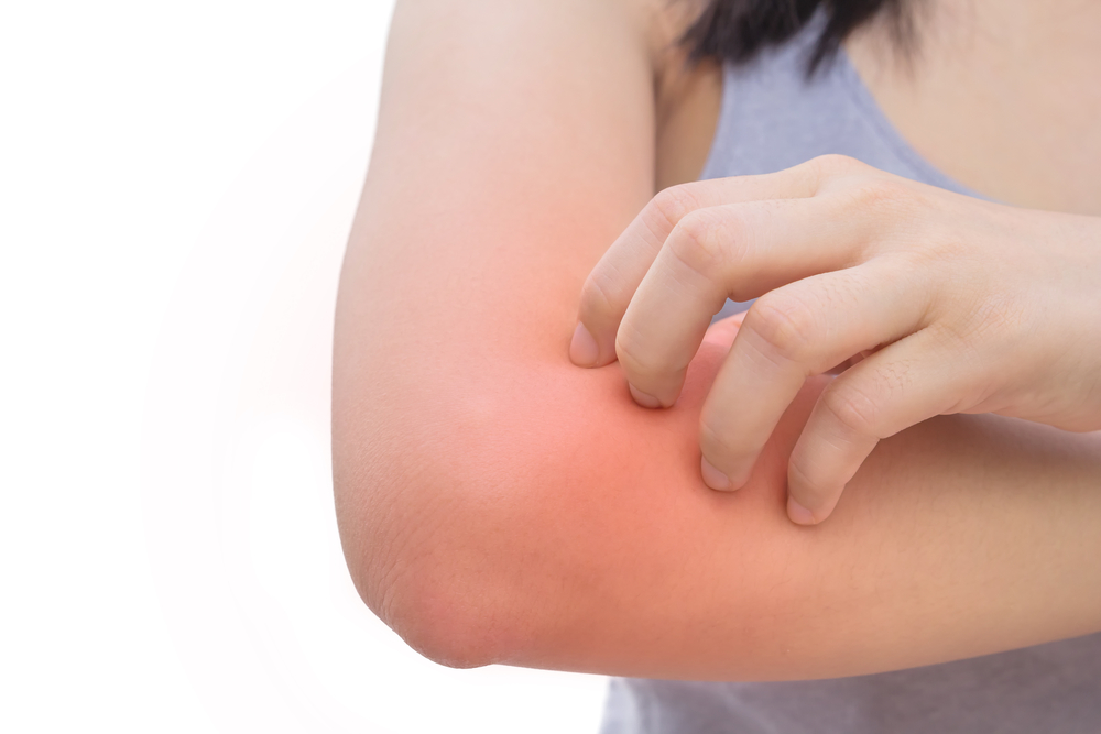 Get Hodgkin's Lymphoma Rash Pictures PNG
