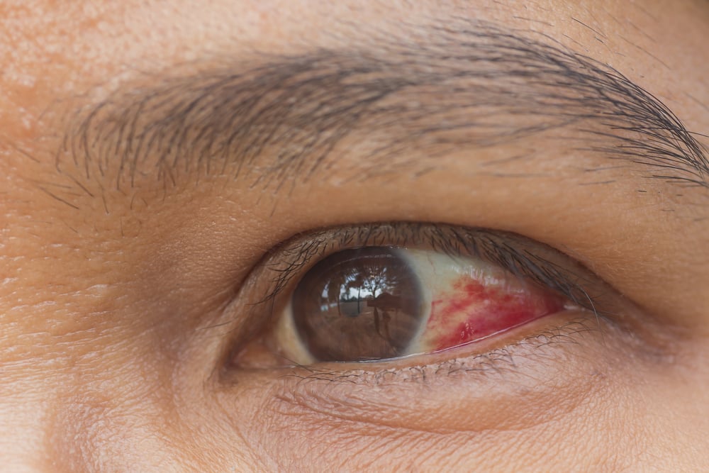 10 Symptoms of Rubella Facty Health