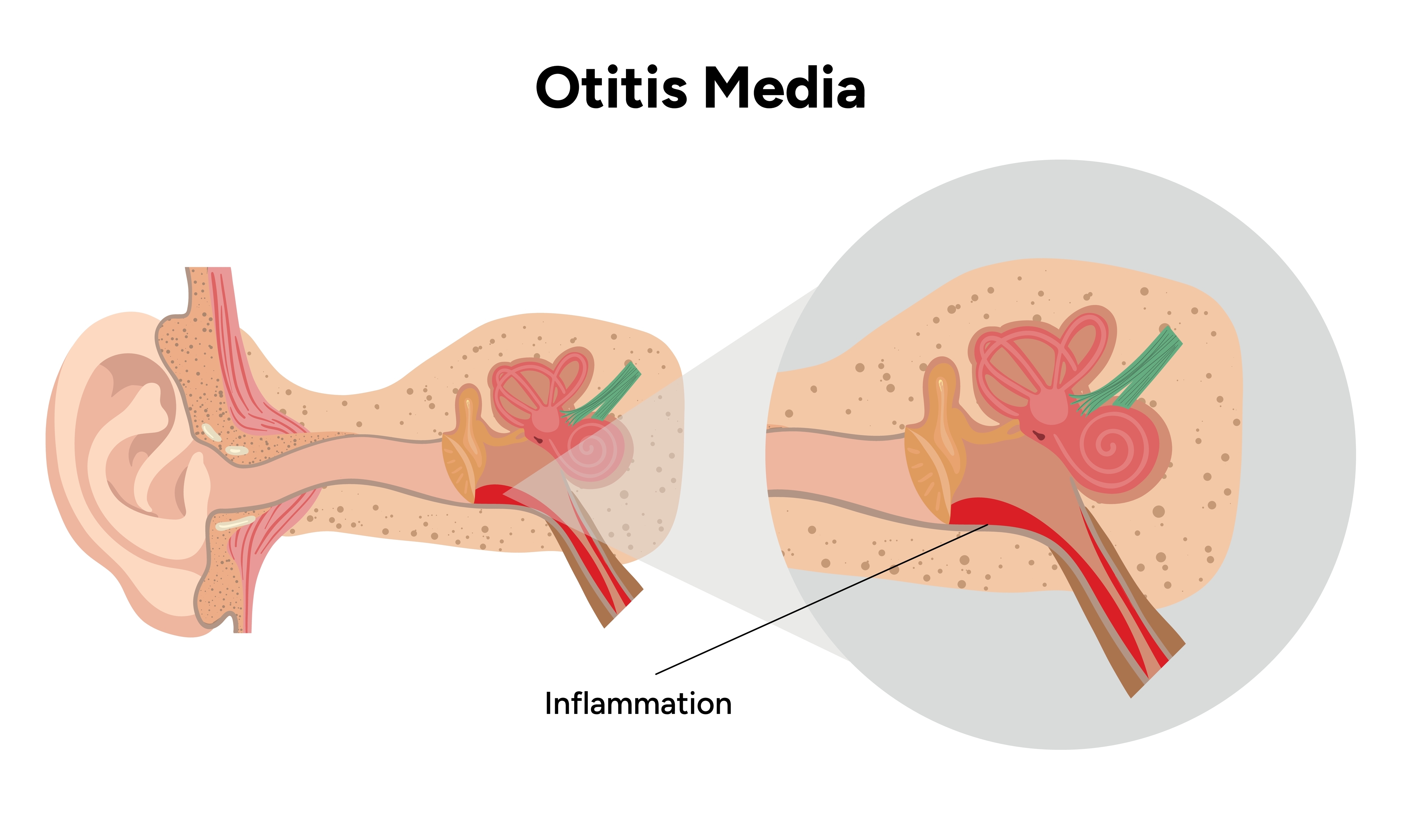 Otitis media inflammation anatomy human ear pain disease medical infographic