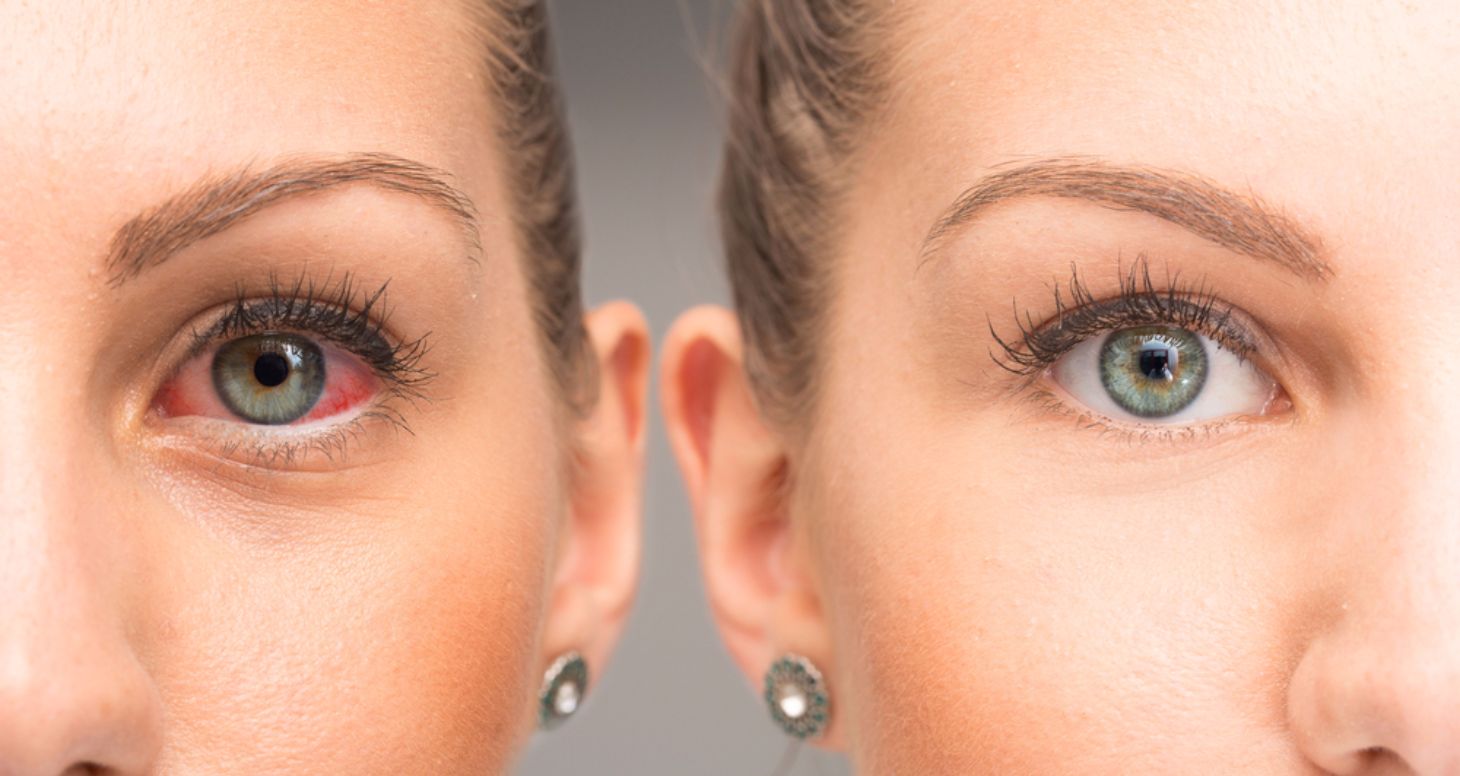 What Causes Red Eyes? Facty Health