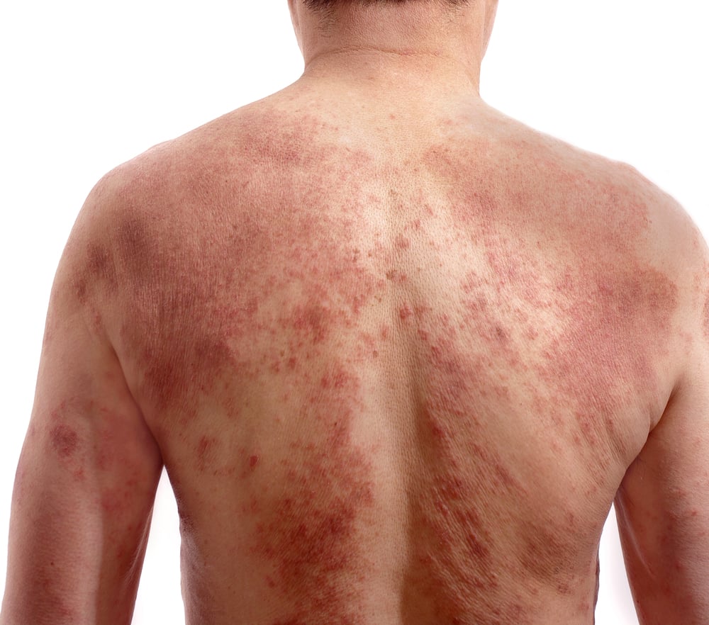 glutathione and sulfa allergy What is glutathione and why must we protect patient access to it?