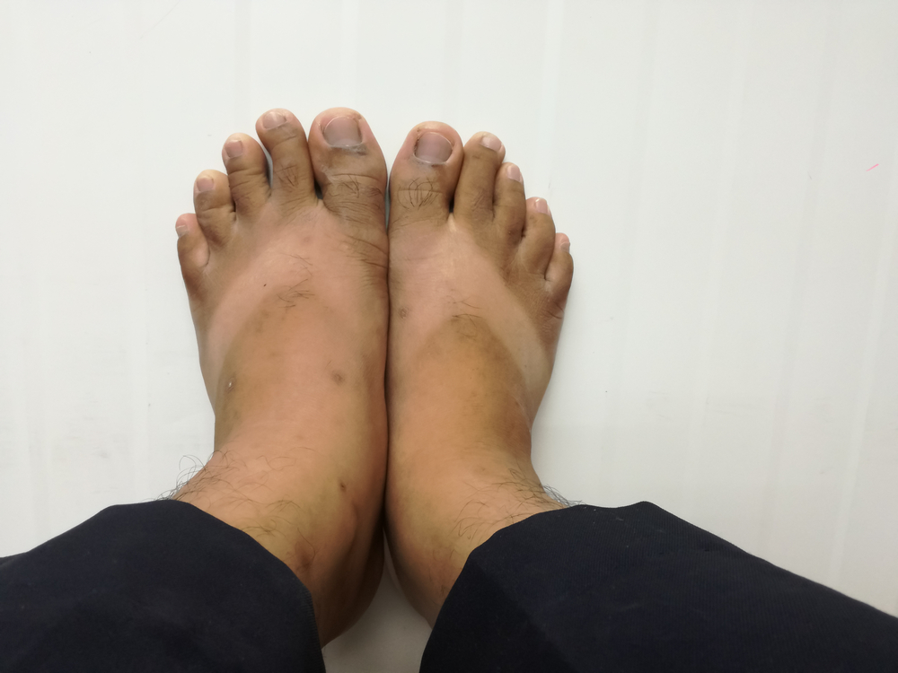 10 Symptoms of Lymphedema - Facty Health