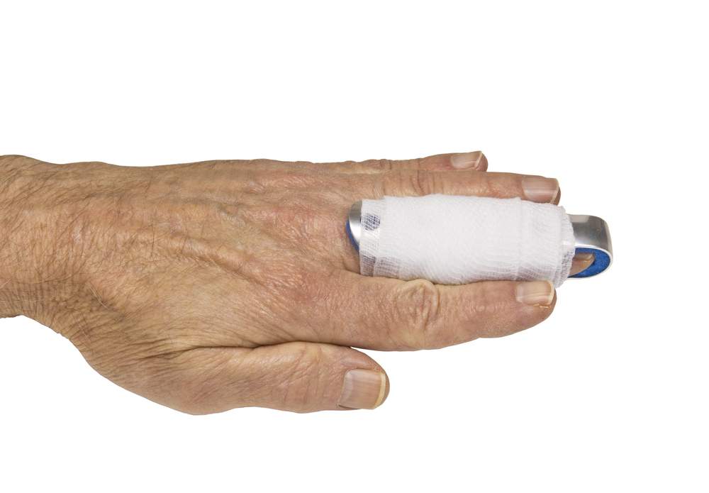 10 Symptoms and Treatments of Mallet Finger Facty Health