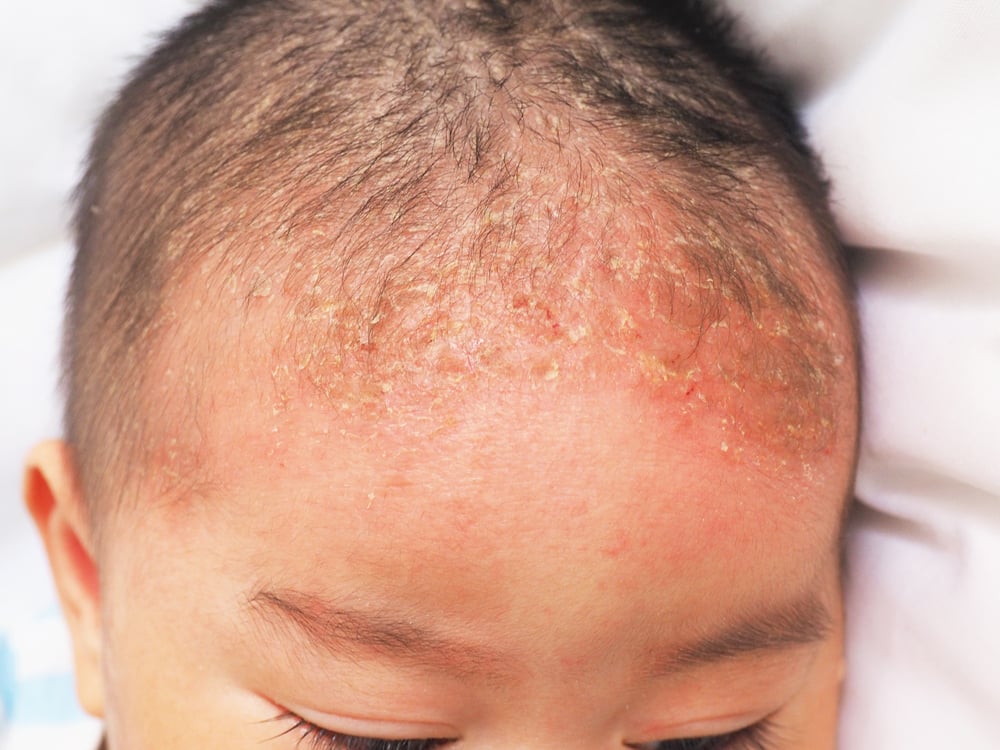 10 Frequently Asked Questions about Cradle Cap Facty Health