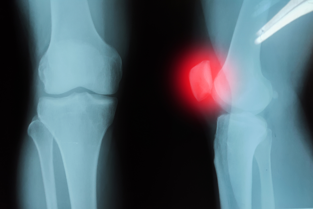 Symptoms, Causes, and Treatments for Septic Arthritis Facty Health