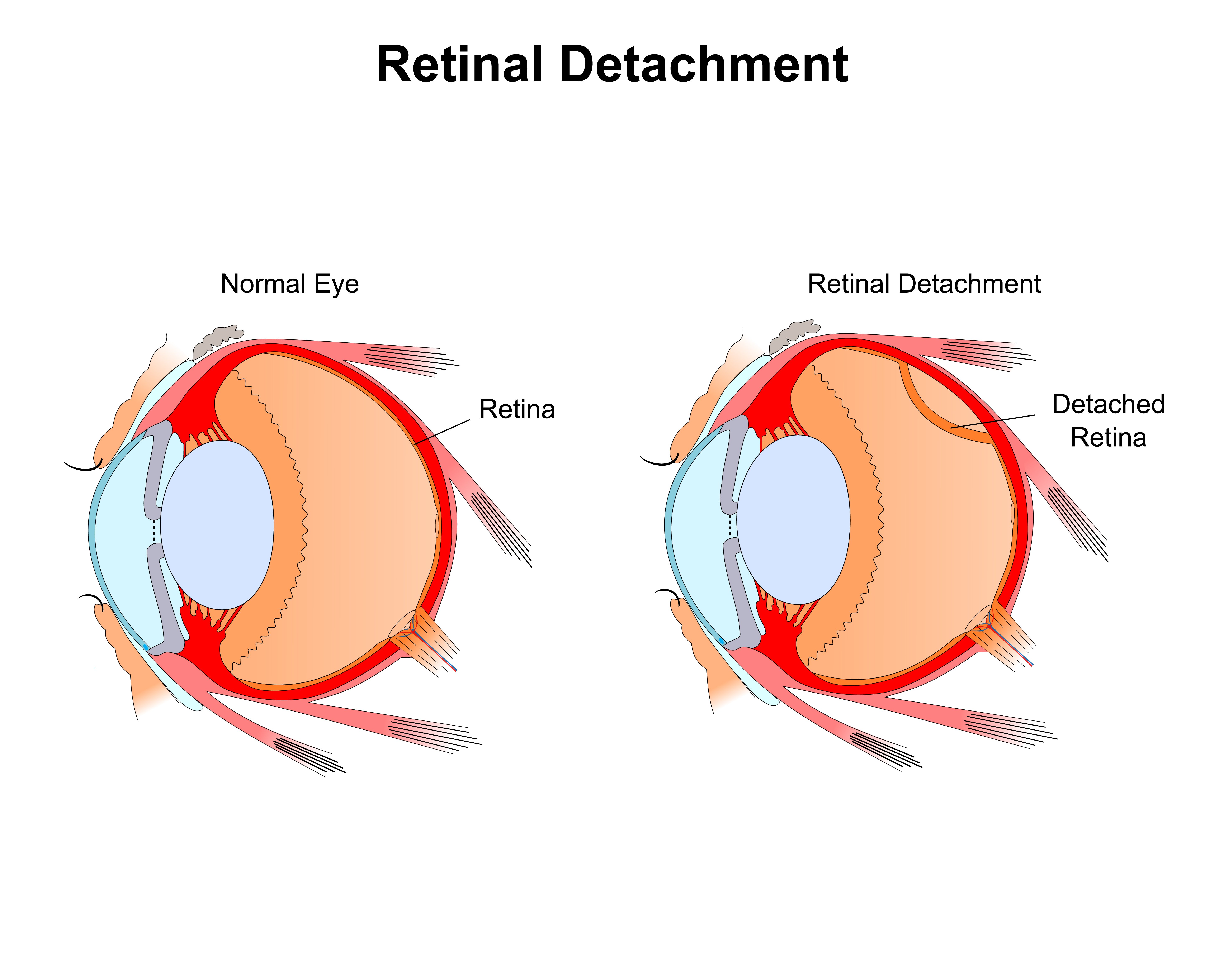 Retinal Detachment color vector illustration