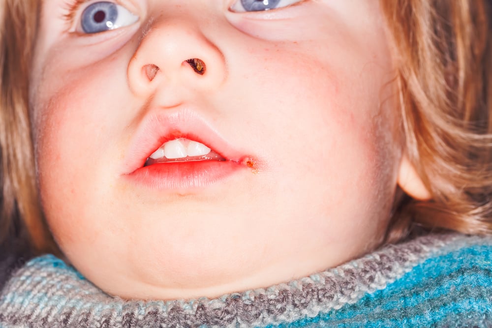 Herpes Simplex: The Hidden Disease - Facty Health