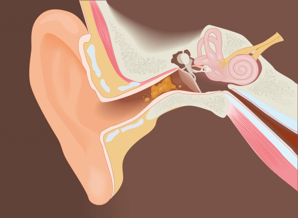 Causes and Treatments for Eustachian Tube Dysfunction Facty Health